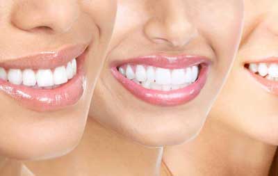 Professional Teeth Whitening